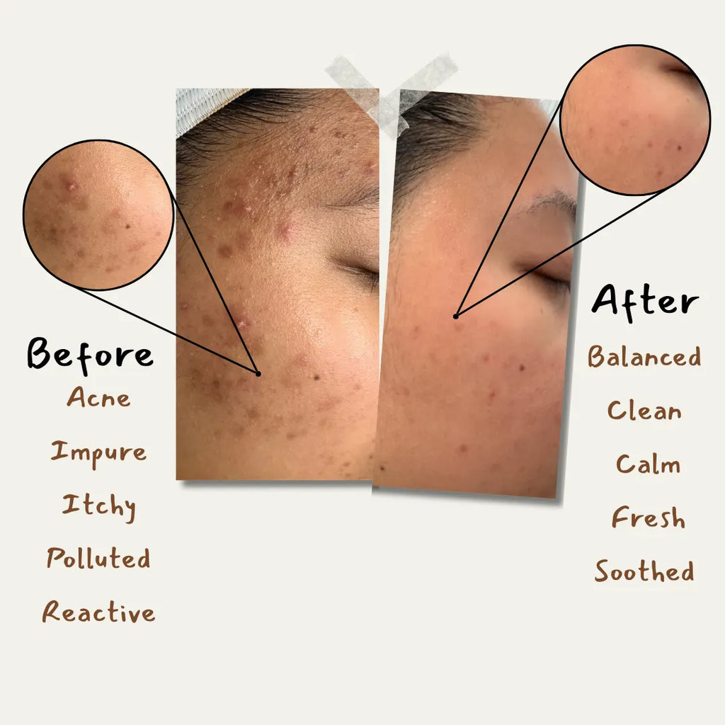 Margosa Trio For Acne Prone Skin + Gift