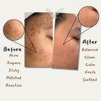 Margosa Trio For Acne Prone Skin + Gift