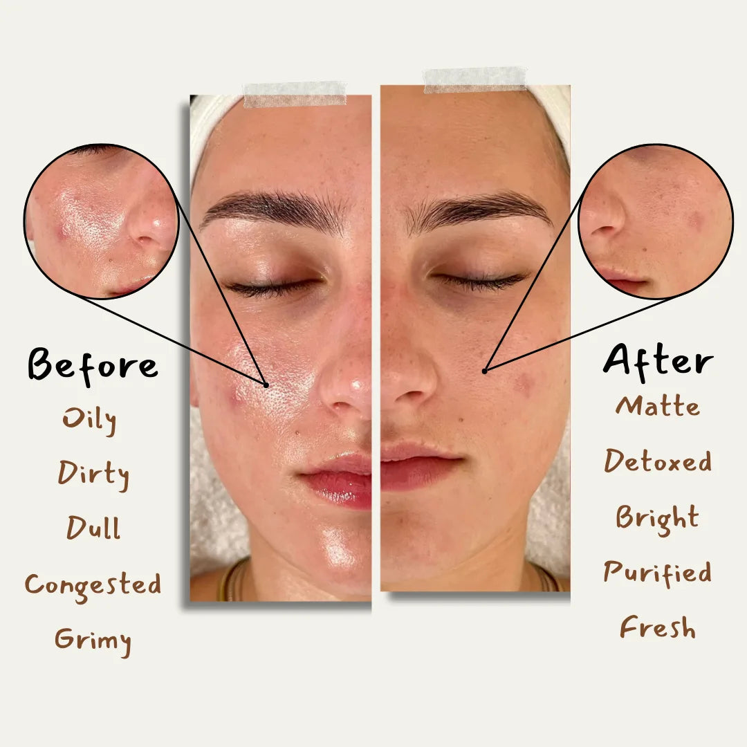 Charcoal Bar For Oily Skin