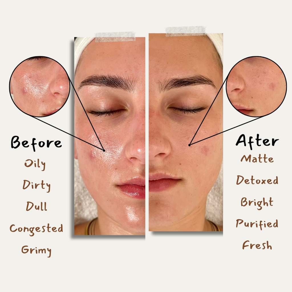 Charcoal Bar For Oily Skin